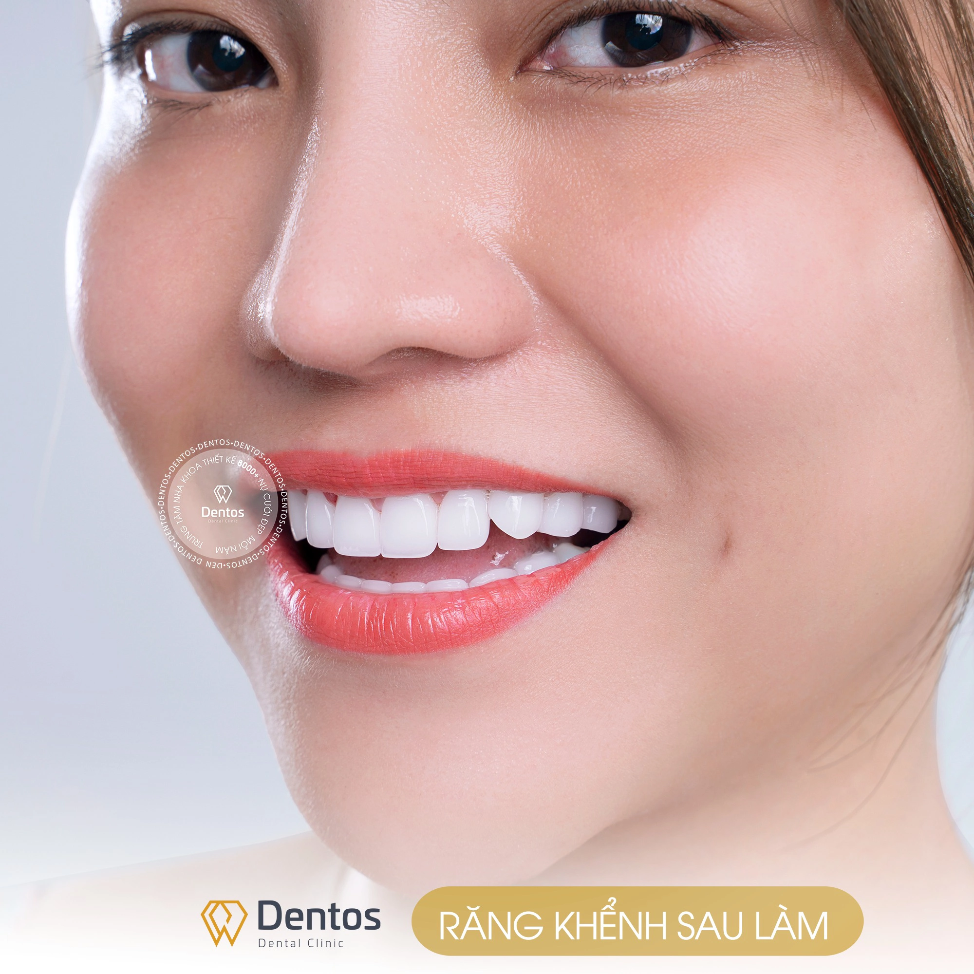 Bọc sứ răng khểnh giúp nâng tầm nét duyên vốn có của bạn